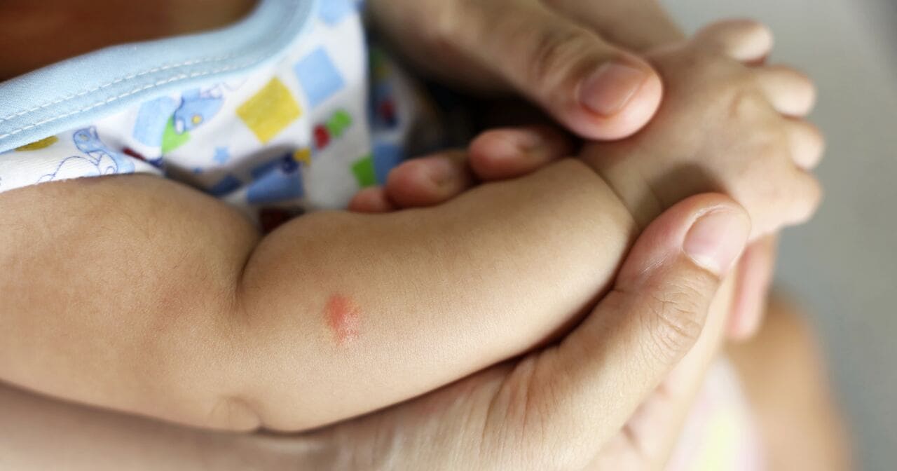 Mosquito bite on baby