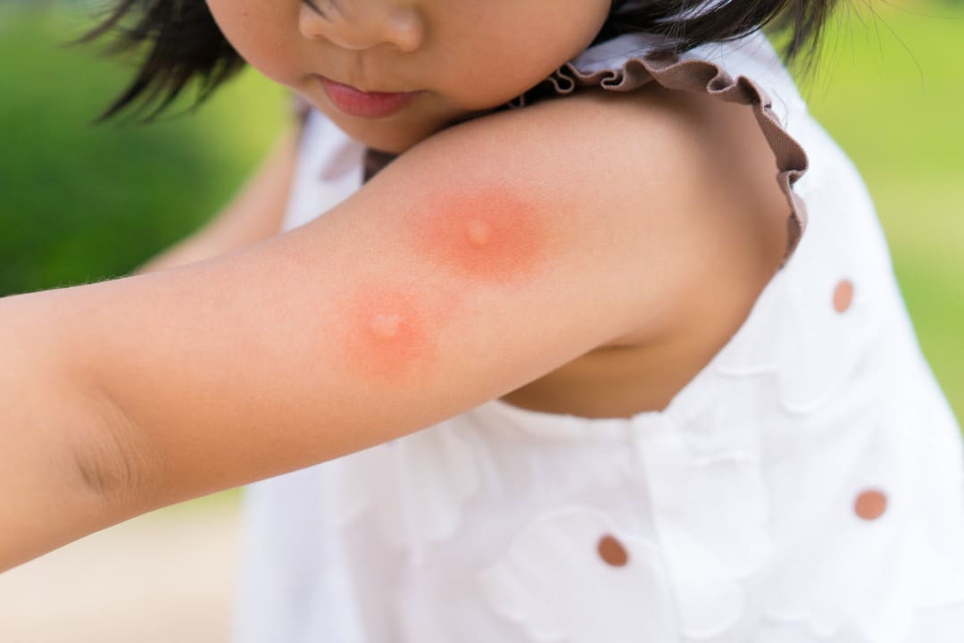 Mosquito bite arm