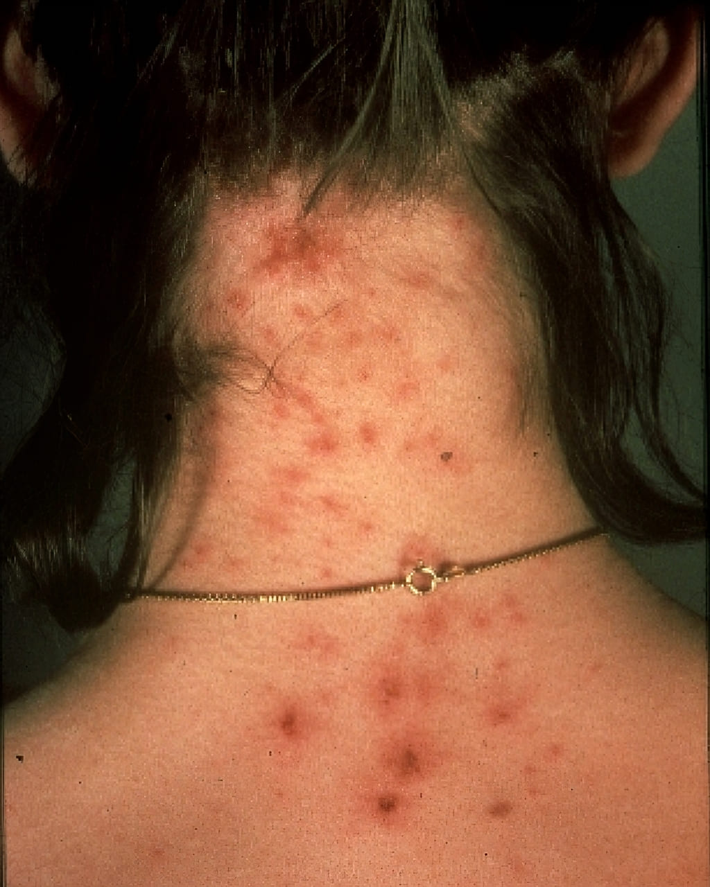 lice bites